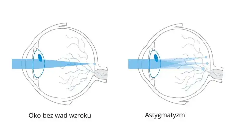 astygmatyzm schemat oka