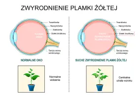 Porównanie zdrowego oka z suchym zwyrodnieniem plamki żółtej. Pokazuje, jak szybko powiększa się otwór plamki żółtej, prowadząc do utraty wzroku.