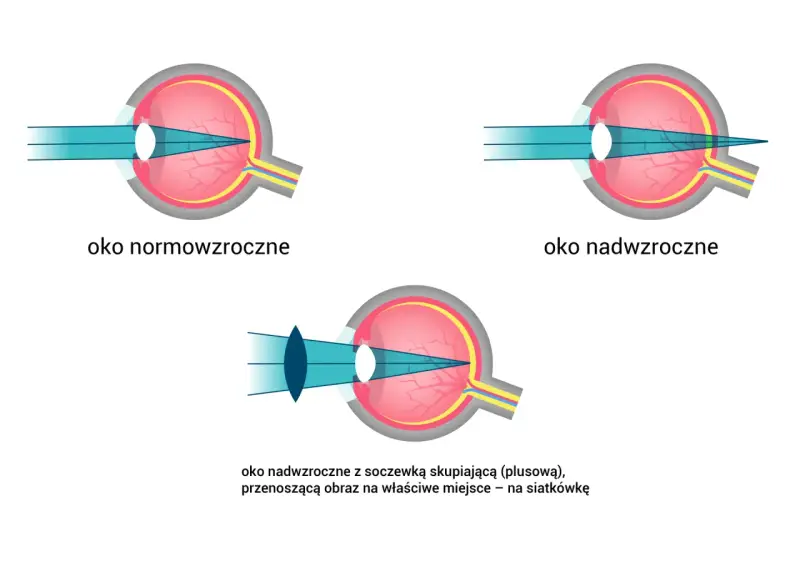 Ilustracja porównuje funkcje oka: normowzrocznego, nadwzrocznego i nadwzrocznego z soczewką korygującą, pokazując skupianie światła na siatkówce.