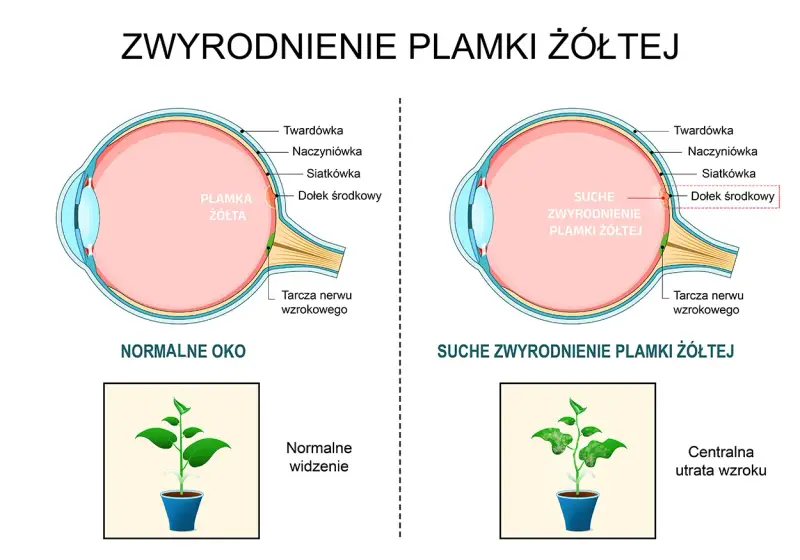 Porównanie zdrowego oka z suchym zwyrodnieniem plamki żółtej. Pokazuje, jak szybko powiększa się otwór plamki żółtej, prowadząc do utraty wzroku.